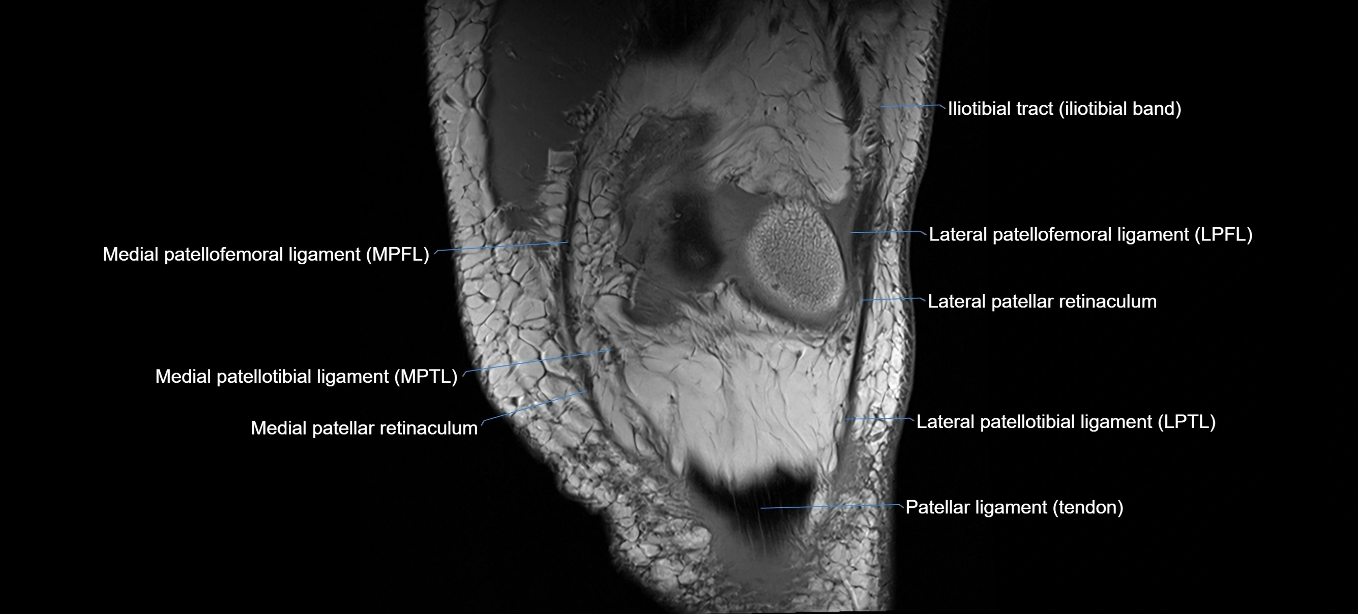 MRI coronal  ligaments cross sectional anatomy 3T  radiology  image-img-04001-00009.webp